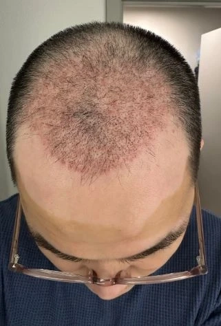 Faster, Safer, Better: New Frontiers in Hair Transplant Healing