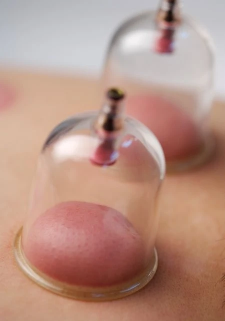 What Is Cupping Therapy? Benefits, How It Works & Precautions