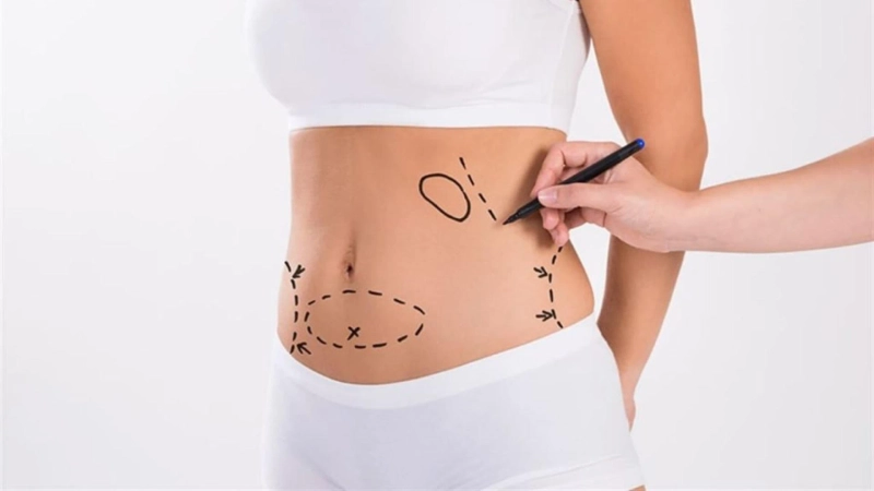 Reshape Your Figure with Advanced Liposuction in Dubai