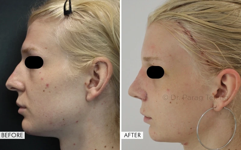 Facial Feminization Surgery Results : Before & After Photos