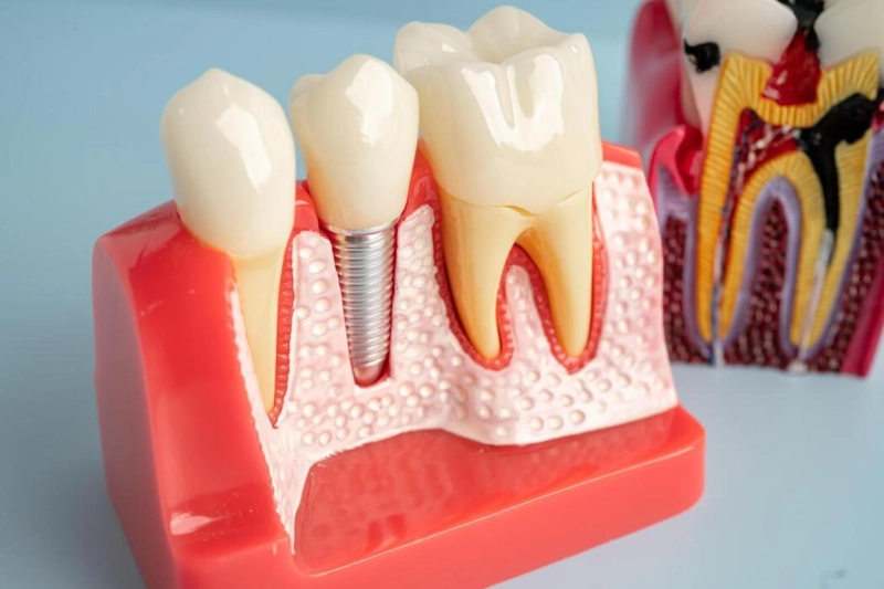 Aftercare Tips for Successful Dental Implant Treatment