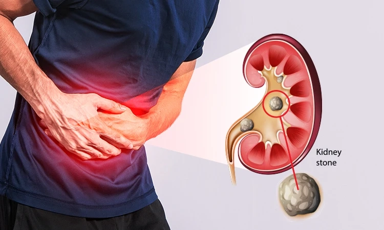 How painful is kidney stone treatment?
