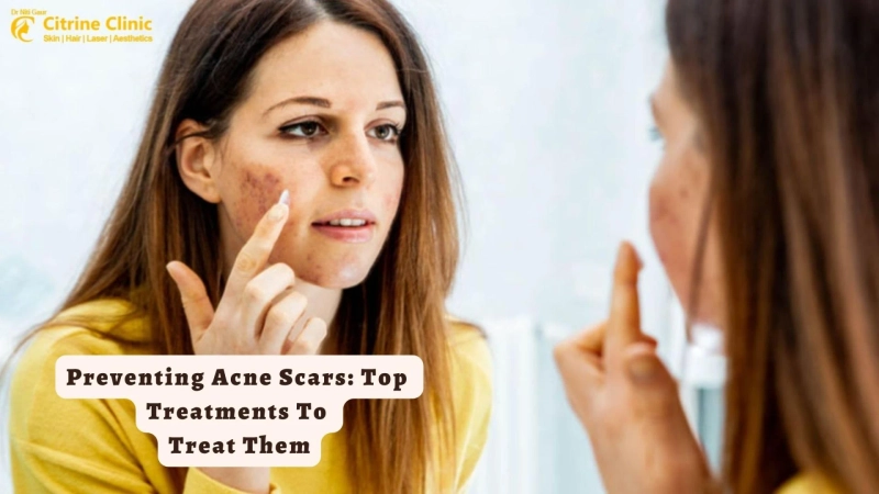 Preventing Acne Scars: Top Treatments To Treat Them