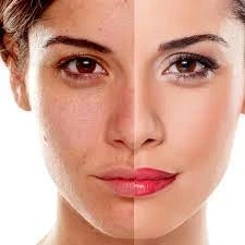 what is Beyond Blemishes: Exploring Advanced Pigmentation Treatment Methods