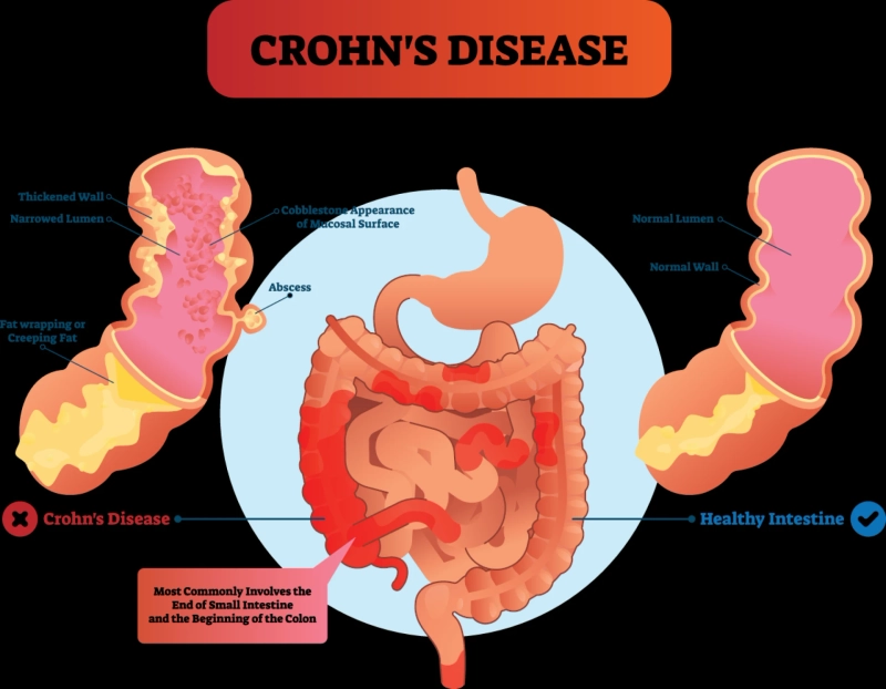 Crohn's Disease in Focus: Competitive Treatment Options