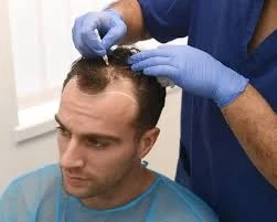 What Makes Hair Restoration in Beverly Hills Effective for Age-Related Thinning Hair?