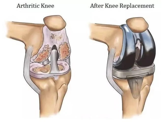 Total Knee Replacement Surgery in Hyderabad - Udai Omni Hospital