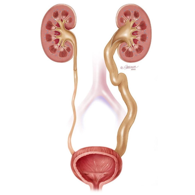 Understanding Obstructive Megaureter: Symptoms, Causes and Treatment