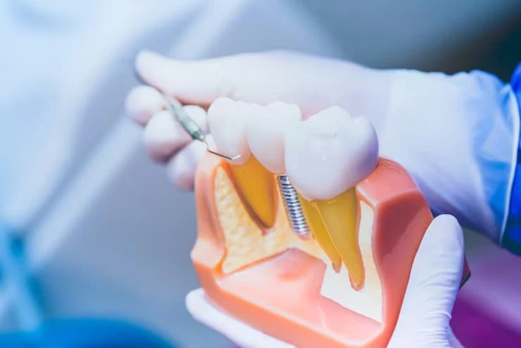 Top Features of the Best Dental Implant Providers in Derby