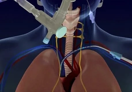 Diaphragm Pacing Therapy System Market 2019 – Huge Growth Opportunities and Expansion by 2025 | Research Informatic