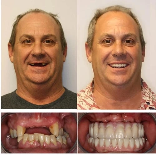 beylikdüzü implant