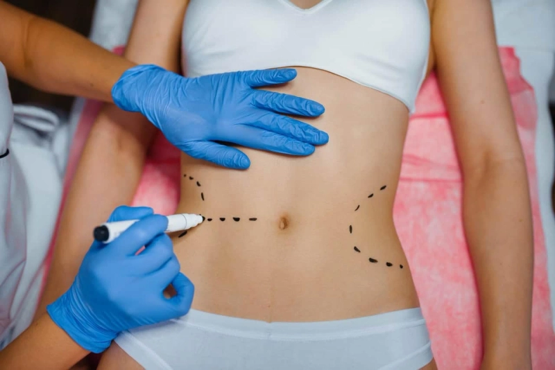Top 10 Myths About Liposuction—Debunked by Experts