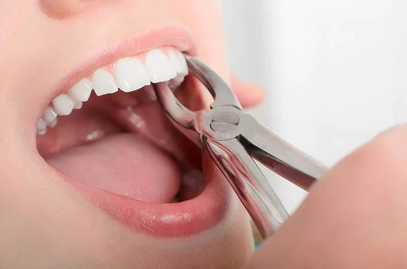 Tooth Extractions: When They’re Necessary and How to Recover Faster