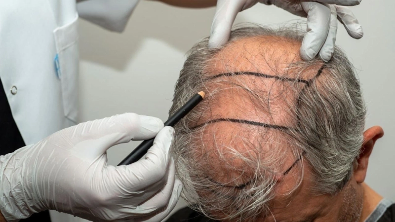 Dubai Hair Transplant Review 2025: Which Clinic Actually Delivers Natural Results?
