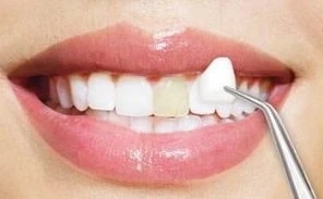 Dental Veneers vs. Teeth Whitening Which is the Best Option Learn @ Mesadentalsd