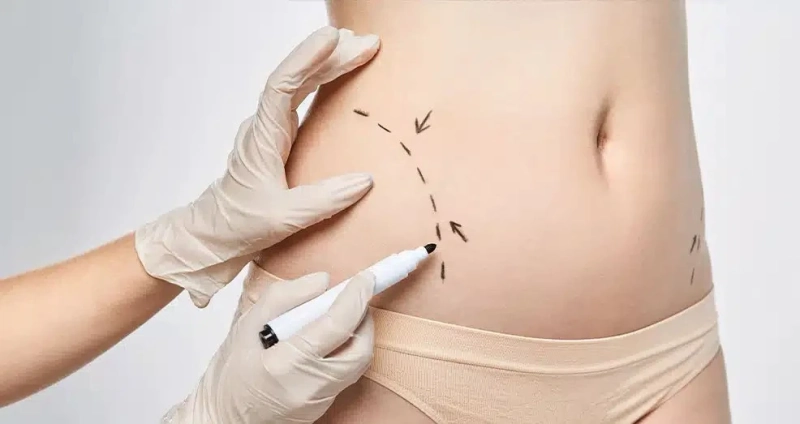 Body Contouring in Dubai: What to Expect from the Procedure