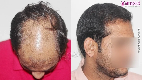 How To Find The Best Hair Transplant Clinic In Gurgaon?