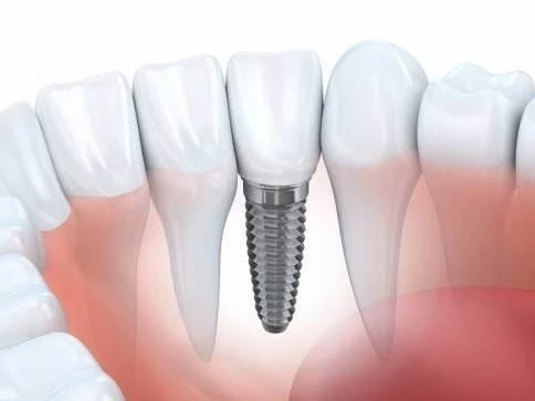 Saudi Arabia Dental Bone Graft Substitute Market to be dominated by Xenograft type through 2028