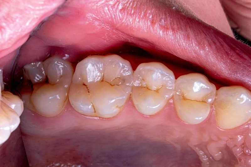 Single Tooth Gum Swelling: Understanding the Causes