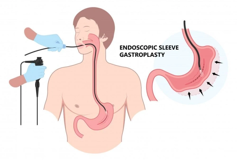 How Endoscopic Sleeve Gastroplasty Supports Healthy Lifestyle Changes