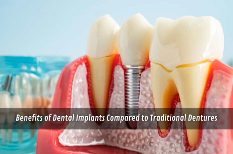 Benefits of Dental Implants Compared to Traditional Dentures
