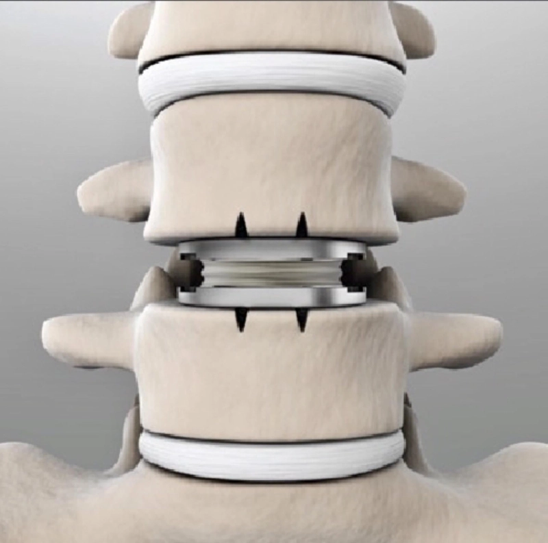 The Pros and Cons of Lumbar Disc Replacement Device vs Lumbar Fusion Surgery