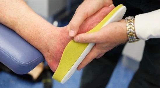 Charcot Foot and Diabetes | Specialty Care Clinics