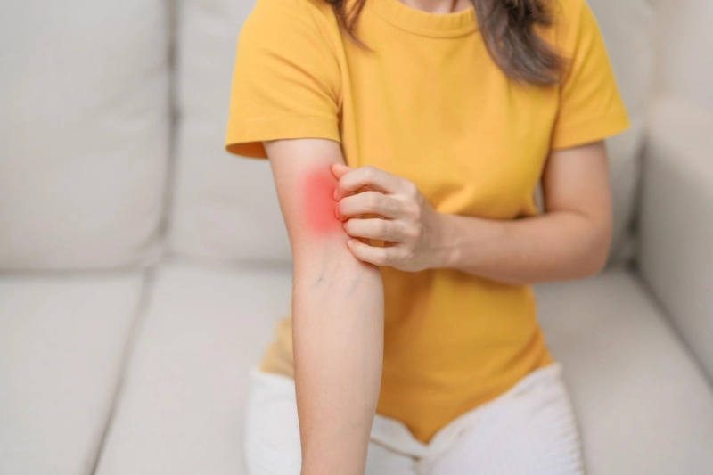 Cutaneous Lupus Clinical Trial Looking For Participants to Advance Life-Changing Treatments