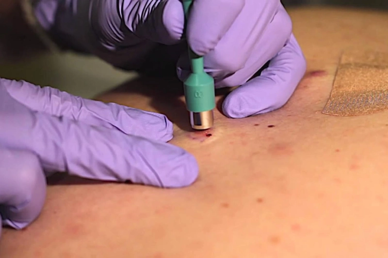 Technological Advancements and Innovations in Dermatology Boost the Skin Biopsy Industry