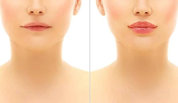The Cost of Lip Injections in New Jersey