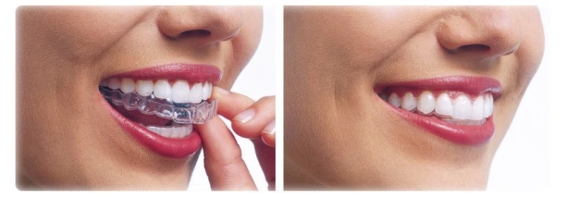 How Aligners Are Transforming Patient Experience