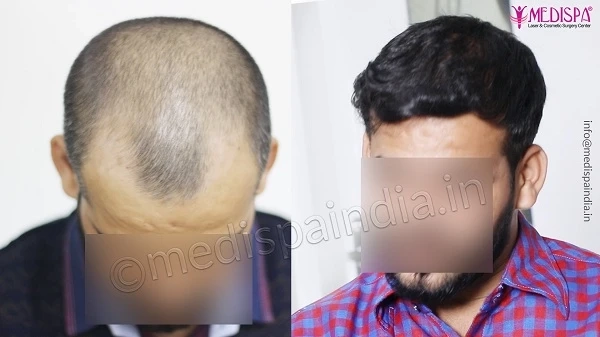 How To Improve Hair Growth Rate After Hair Restoration?