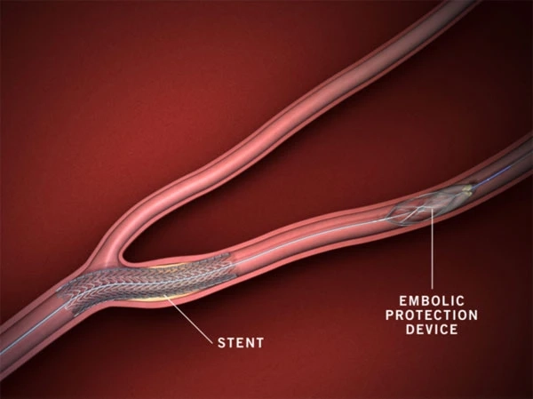 Embolic Protection Devices Market Size, Share, Opportunities With Key Players Analysis, 2028