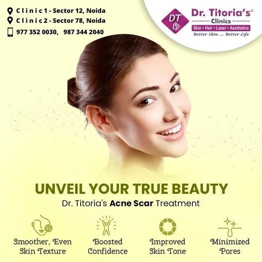 The Ultimate Guide to Managing Acne: Trusted Advice from Noida's Top Skin Clinics