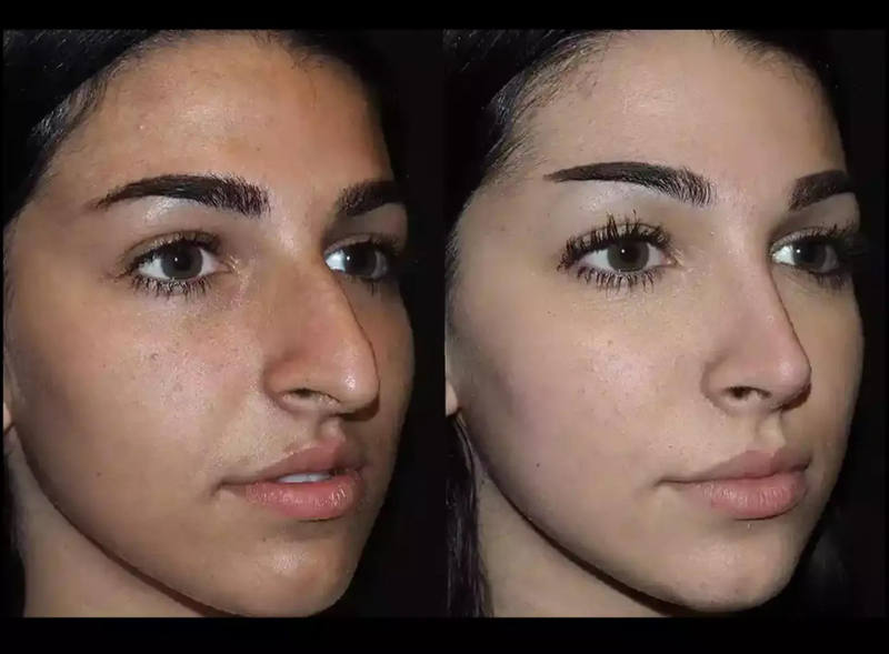 Best Rhinoplasty Surgeons in Dubai Before and After Insights