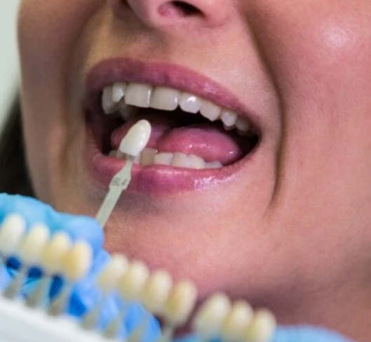 Your Guide to a Confident Smile: Finding the Right Composite Veneers Nearby