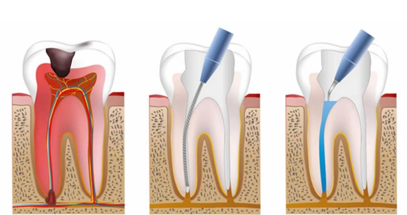 Understanding the Causes of Root Canal Treatment