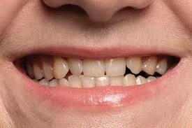 How Vitamin Deficiencies Can Impact the Color of Your Teeth