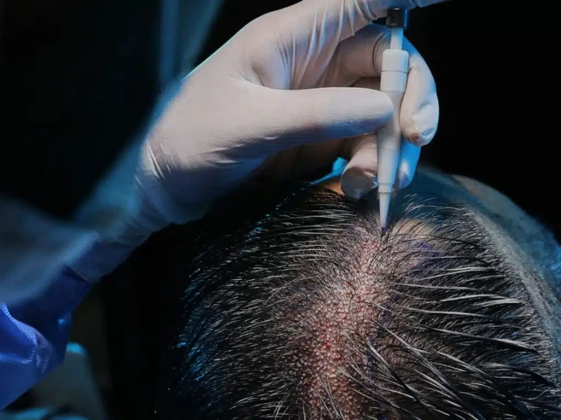 Is the cost of hair transplant in Dubai refundable if results are unsatisfactory?