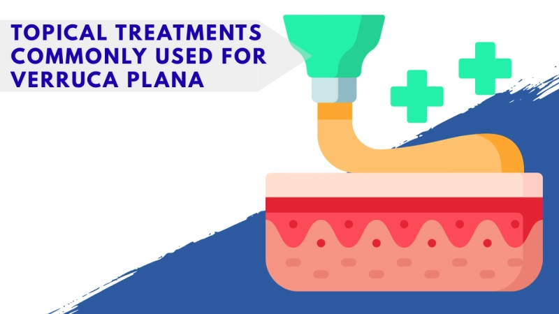 Topical Treatments Commonly Used for Verruca Plana