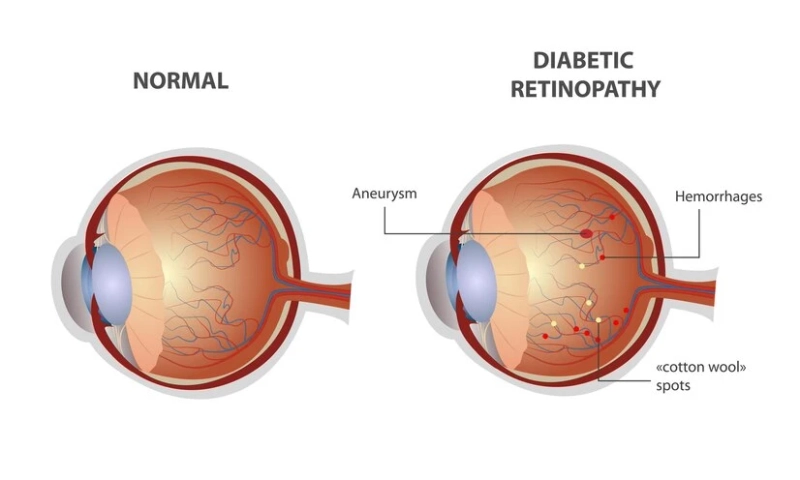 Diabetic Retinopathy: More Than Just Sugar in Your Eyes