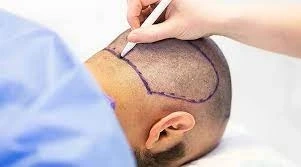 Hair Transplant Surgery Cost in Dubai UAE