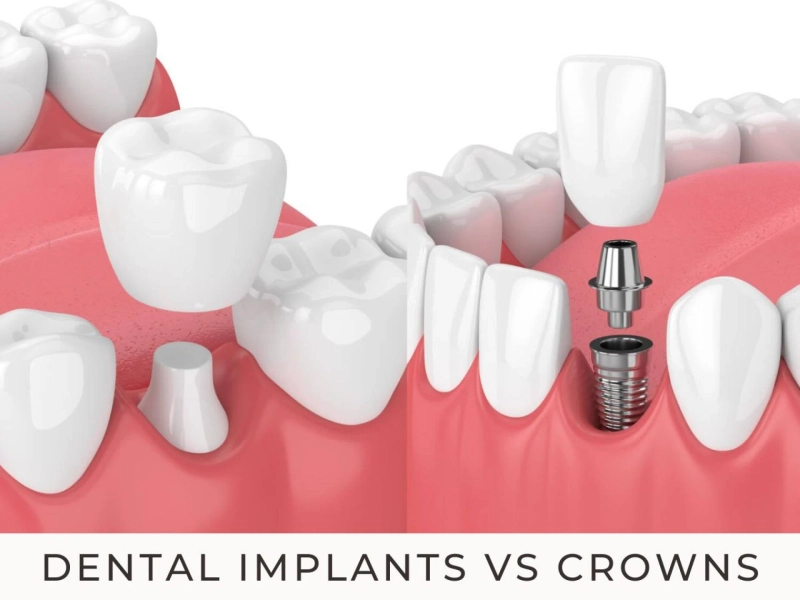 Find Out The Difference Between Dental Implants & Crowns