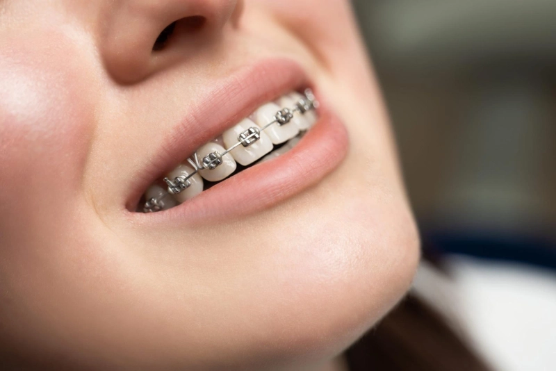 How Many Hours Does It Take for Braces to Stop Hurting?