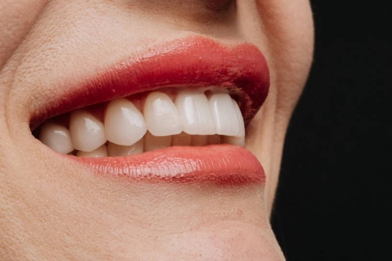 How Veneer Care Protects Your Overall Oral Health