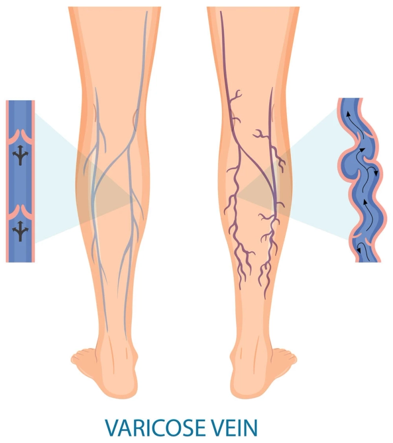 PRP and Varicose Veins Treatment in Kolhapur