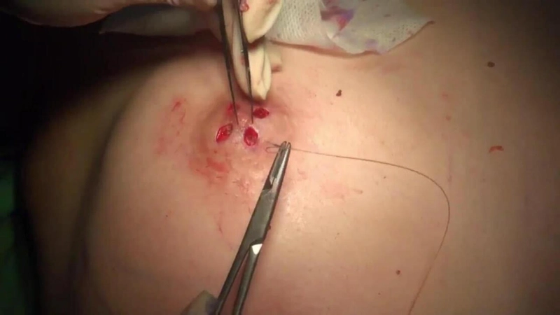Inverted Nipple Surgery: Pros and Cons You Should Consider